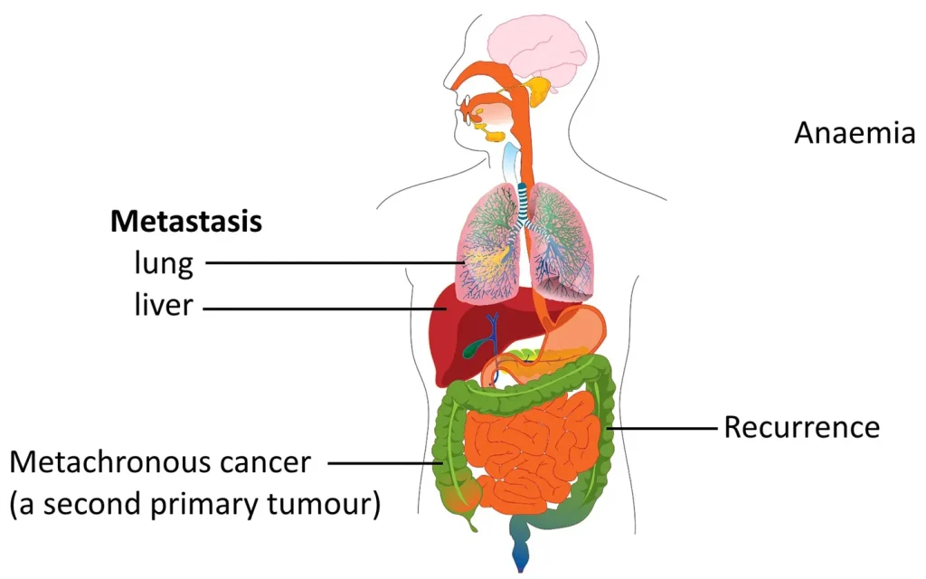 متاستاز سرطان و روش‌های تشخیص، علائم و درمان