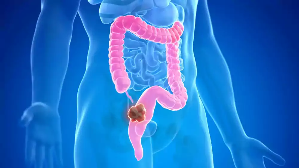 دلیل ابتلا به سرطان روده بزرگ و راست‌روده