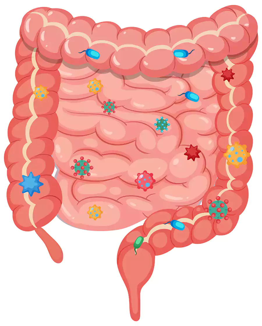 علت IBS چیست؟