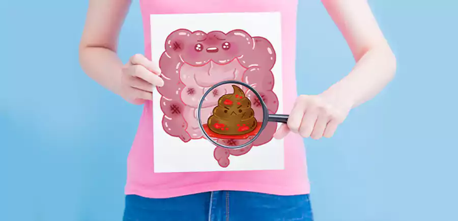 درمان خونریزی مقعدی و خون در مدفوع