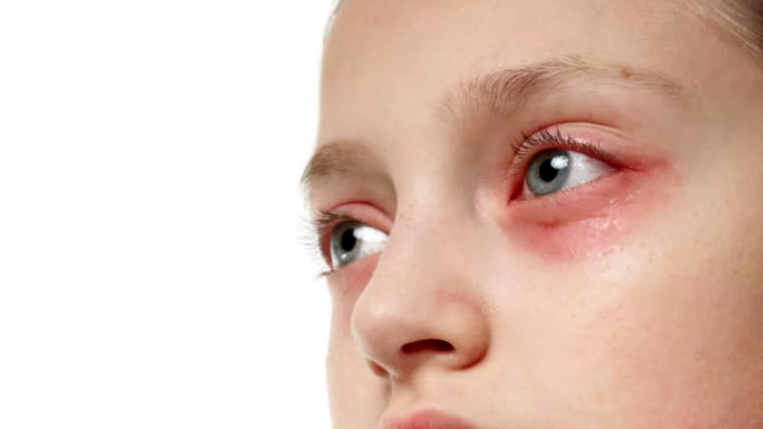 التهاب ملتحمه (کنژنکتیویت) در کودکان