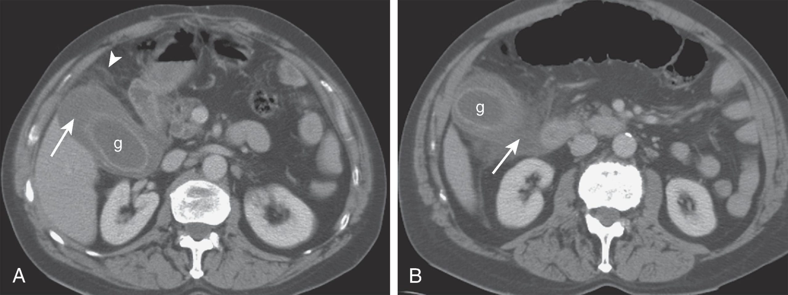 التهاب حاد کیسه صفرا (Akute Cholezystitis)