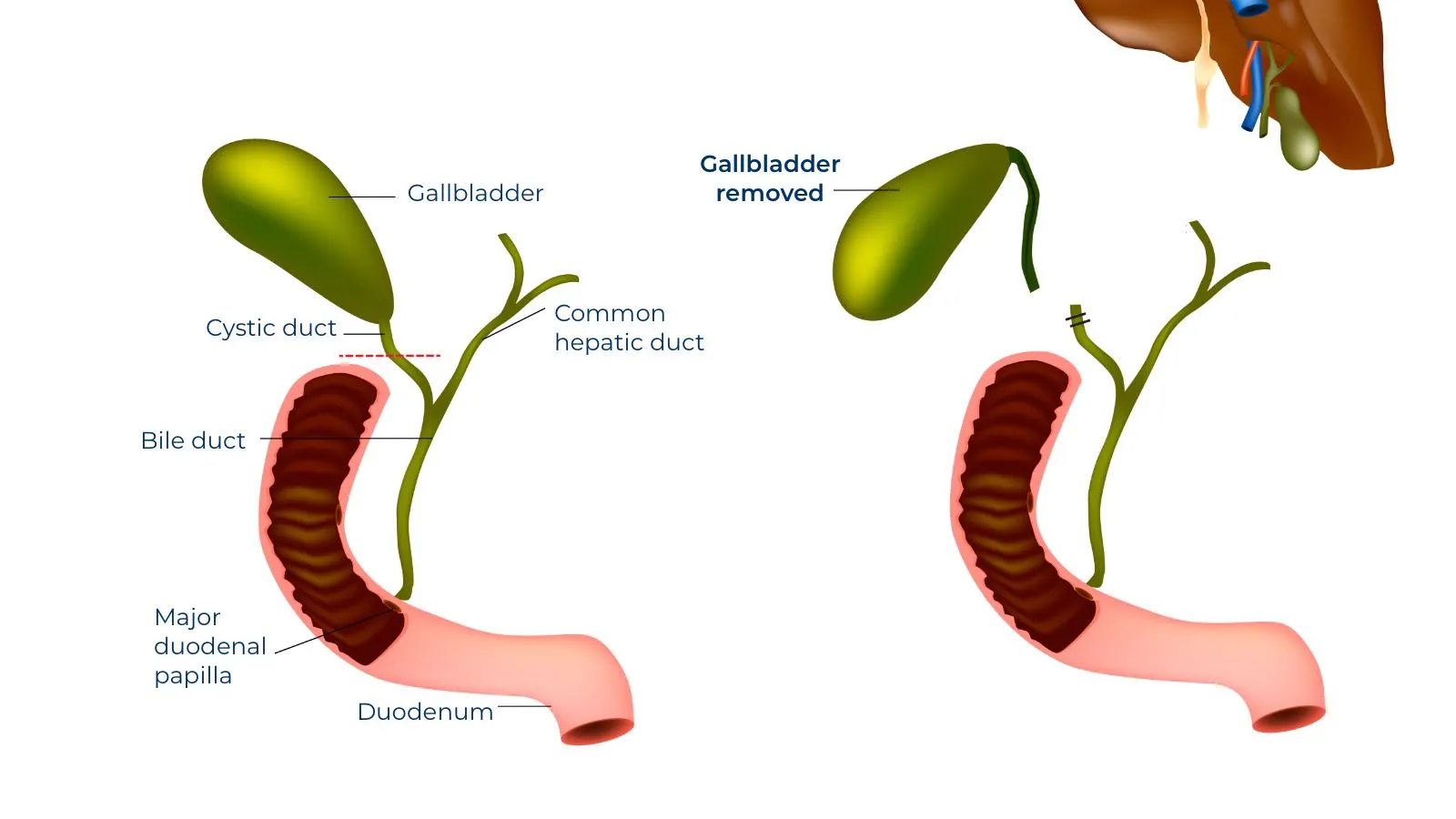 برداشتن کیسه صفرا (کولهسیستکتومی)