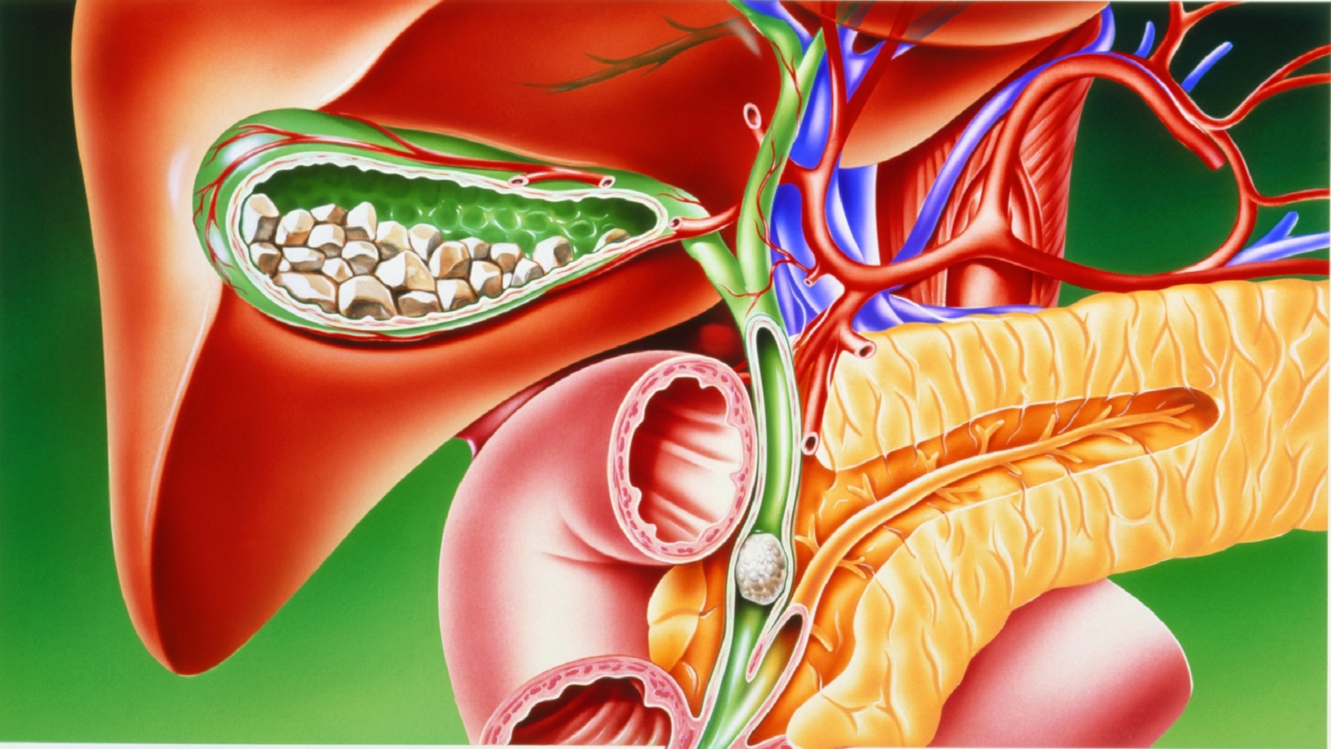 سنگ کیسه صفرا