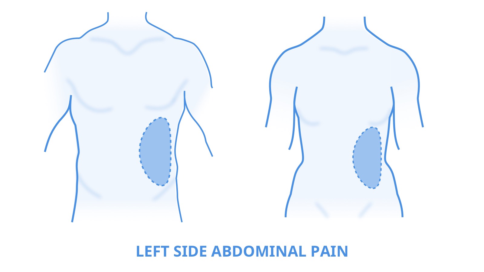 علل شایع درد شکم در سمت چپ