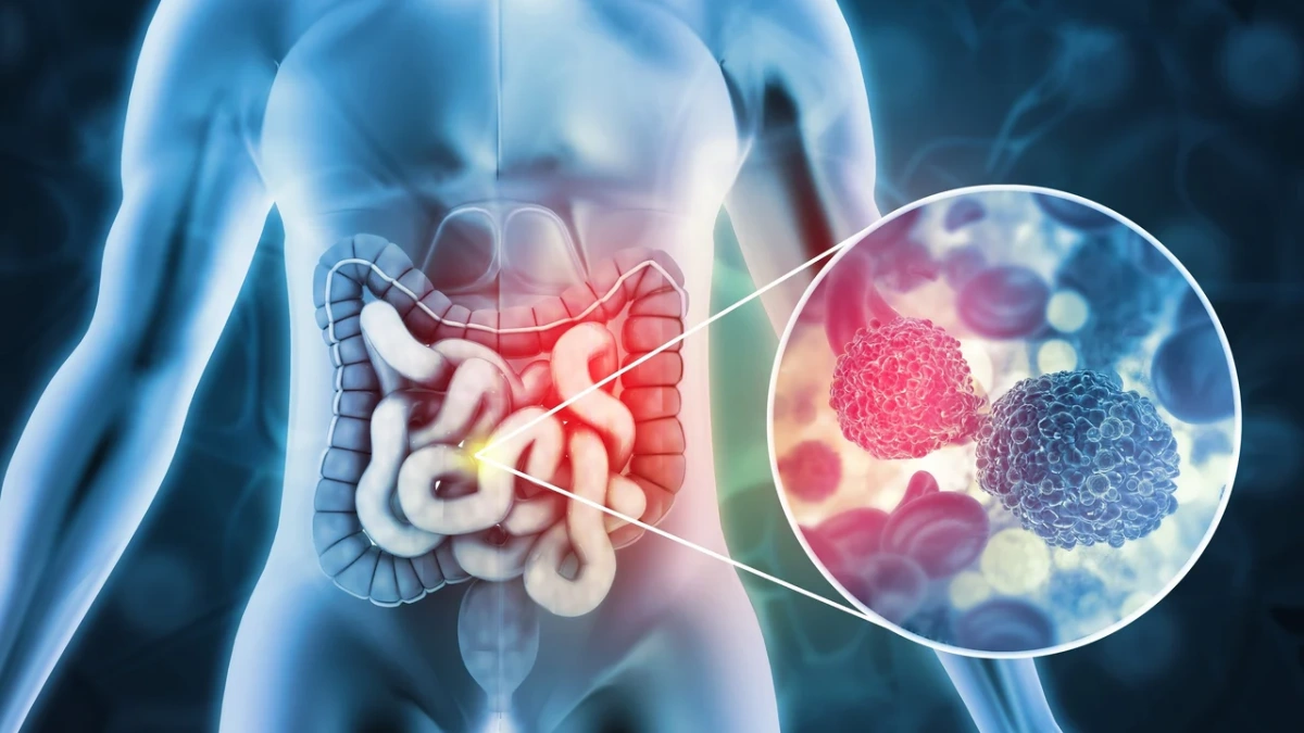 علائم اولیه سرطان روده بزرگ