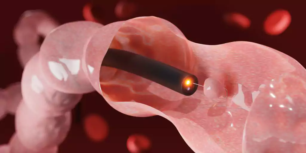 آندروسکوپی روده برای بررسی خونریزی