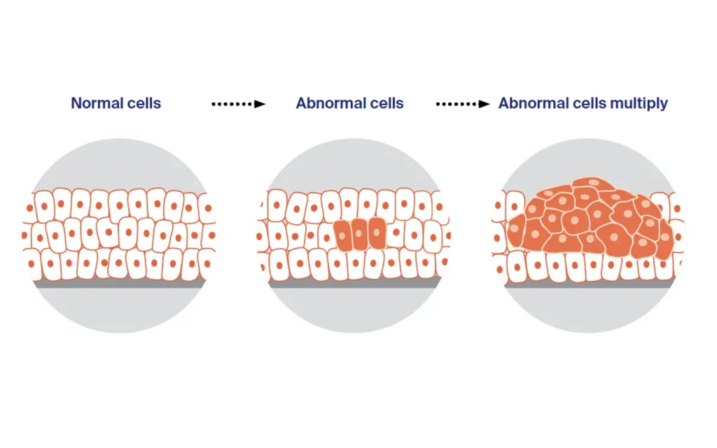 کنترل رشد سلول‌های غیرطبیعی و انتخاب روش درمان مناسب