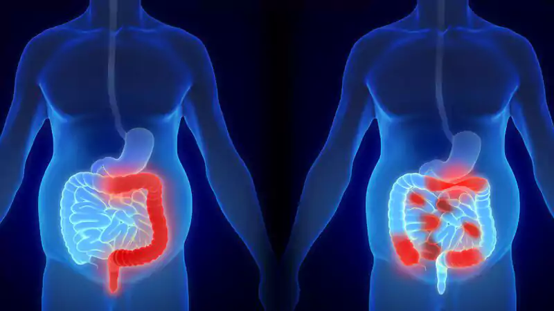 تشخیص زودهنگام سرطان روده 