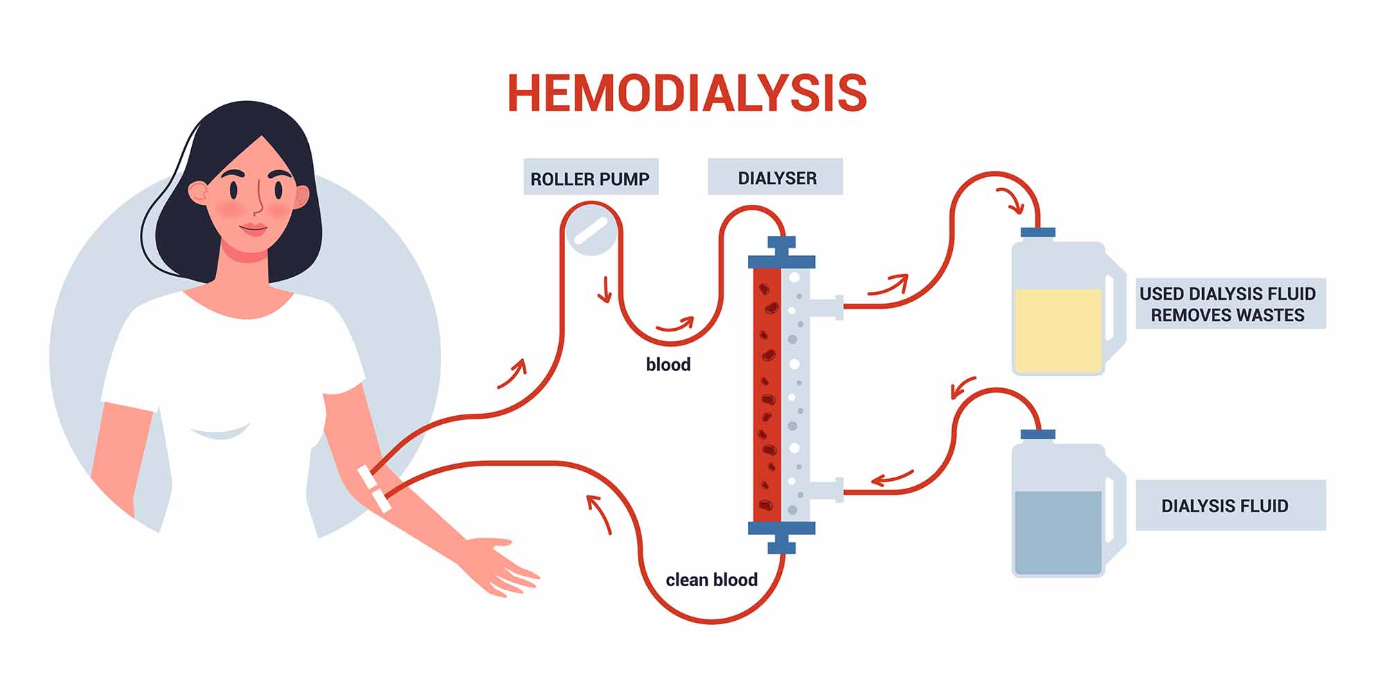 همودیالیز چگونه کار می‌کند؟