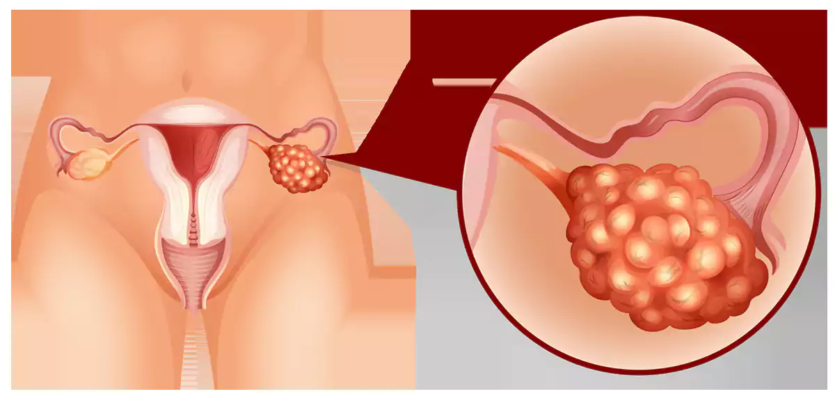 علائم سندرم تخمدان پلی‌کیستیک
